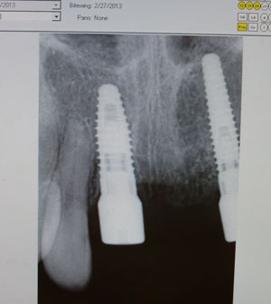 implant02271302.jpg